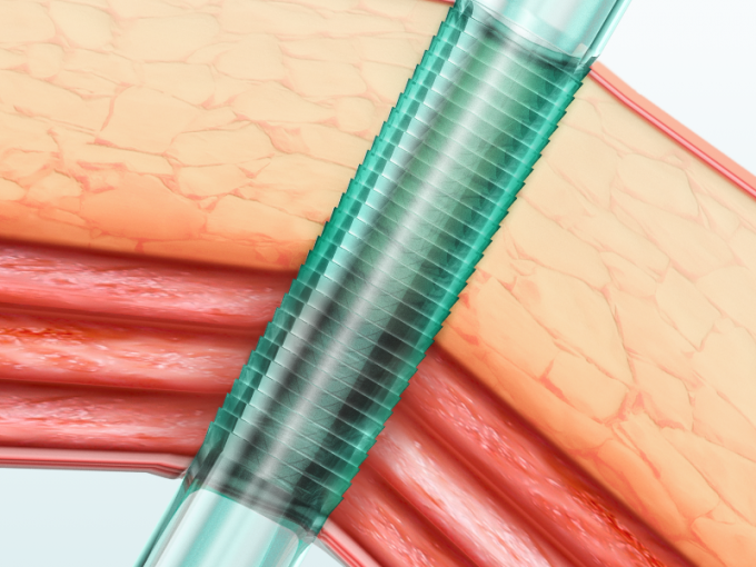 Trocar Optik 5mm Untuk Sekali Pakai, Trocar Laparoskopi Dan Kanula Kelas II 0