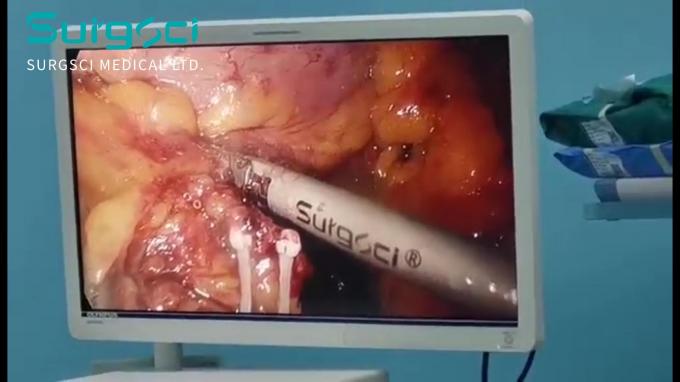 kasus perusahaan terbaru tentang Kasus Penggunaan Pisau Bedah Ultrasonik | Operasi Kanker Usus Besar | Surgsci 0