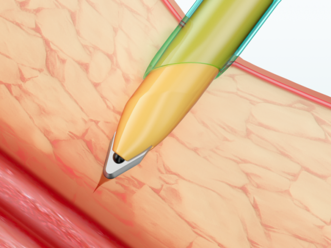 Instrumen Laparoskopi Kanula Trocar Sekali Pakai Dengan Pisau 1