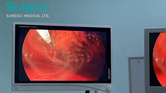 berita perusahaan terbaru tentang Hernia: Penyebab, Jenis, dan Pilihan Pengobatan | Surgsci  0